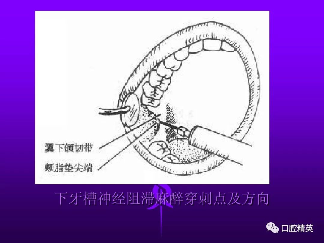 口腔局部麻醉