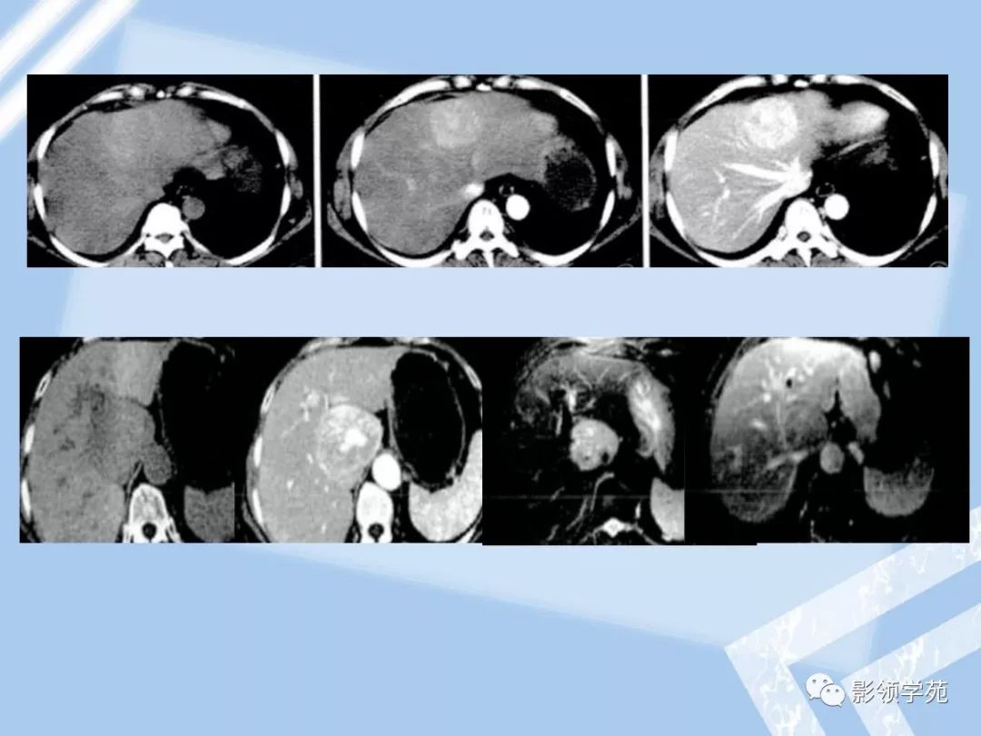 将其分为3 类:成人婴儿型肌纤维瘤病 infantile type myo