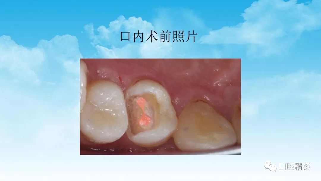 前磨牙根管治疗后高嵌体修复1例