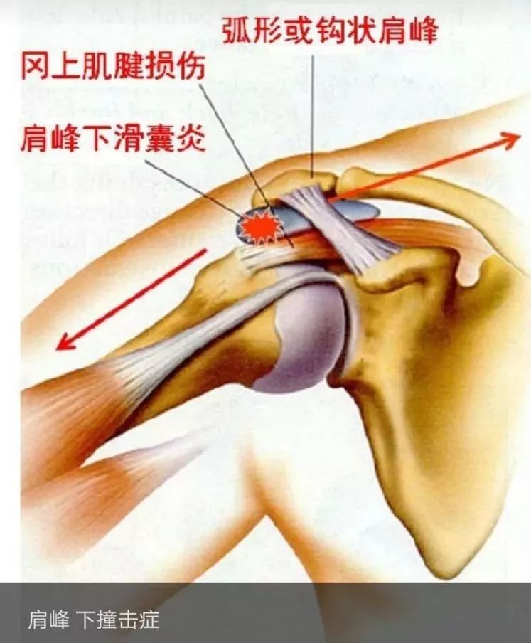 肩袖损伤?啥是肩袖?跟肩周炎有什么区别?