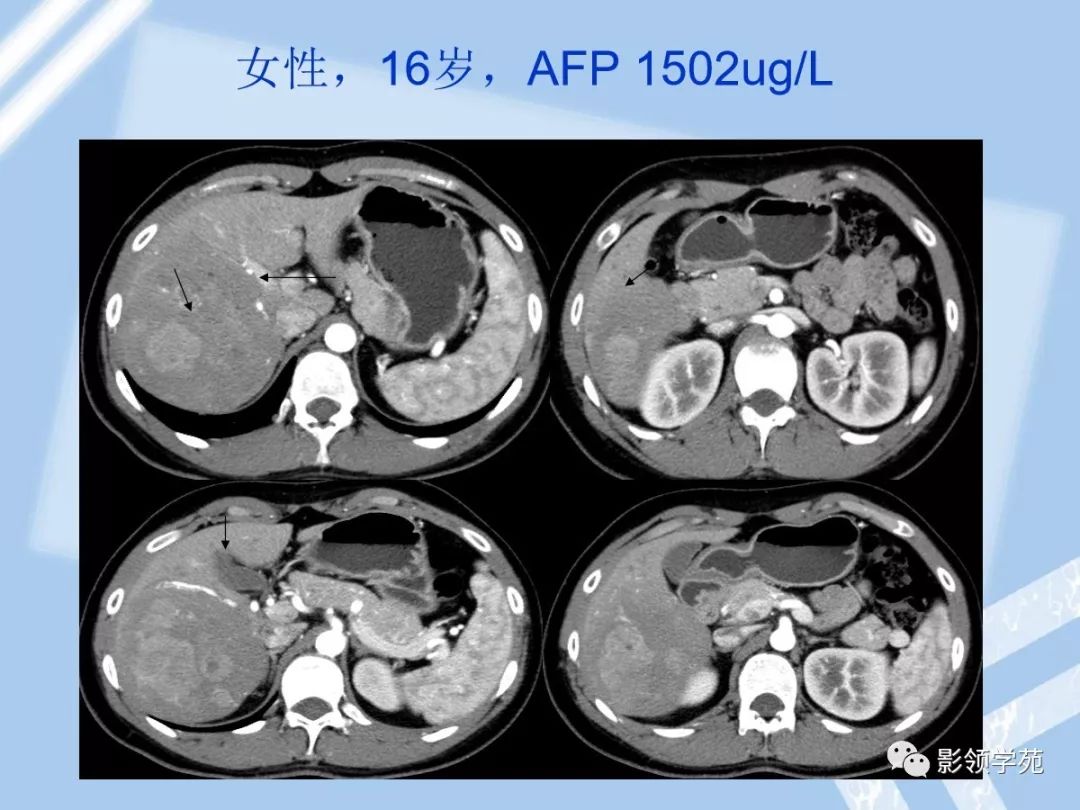 22种肝脏少见及不典型肿瘤的影像表现_门静脉
