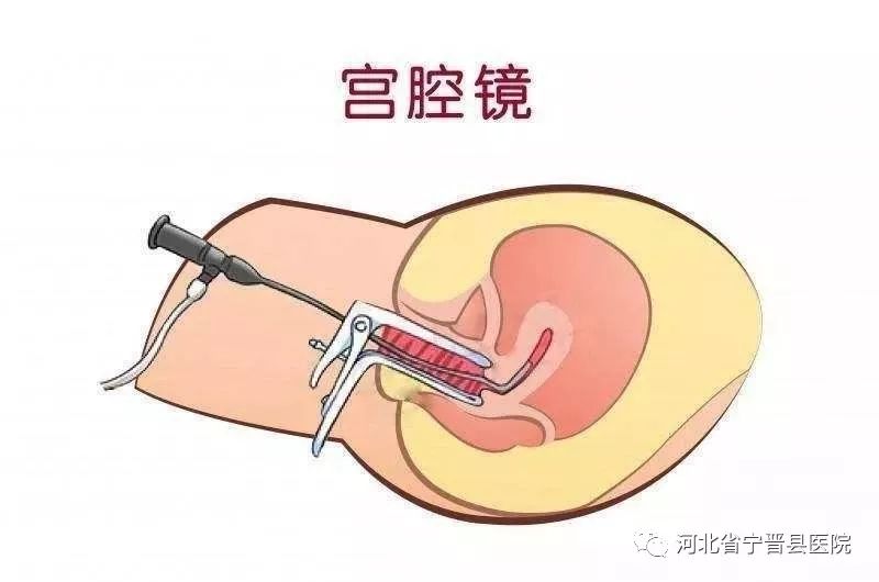 02 宫腔镜的优点是直观,准确,不痛,不伤子宫,被誉为治疗不孕不育的"