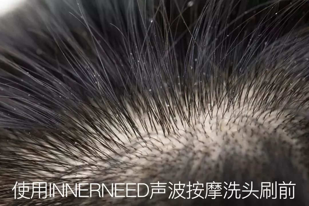 爽到呻吟!60s清洗头皮5800次,从此不出油不脱发,众筹秒爆
