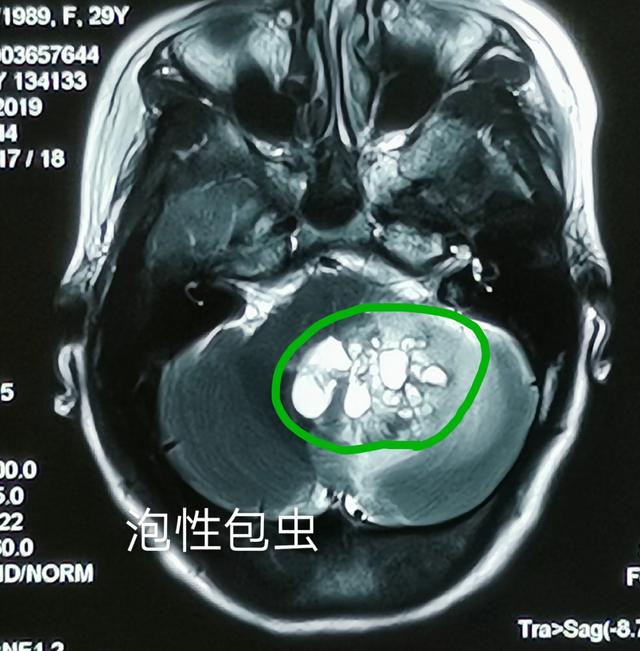 脑包虫病患者棘球蚴逐渐增大,造成颅内占位效应,并对脑室系统压迫和