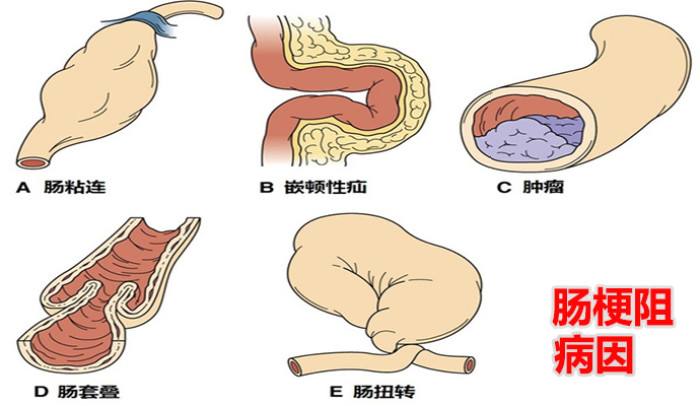 疼痛一旦转移到右下腹,之前那些疼过的部位就不疼了.