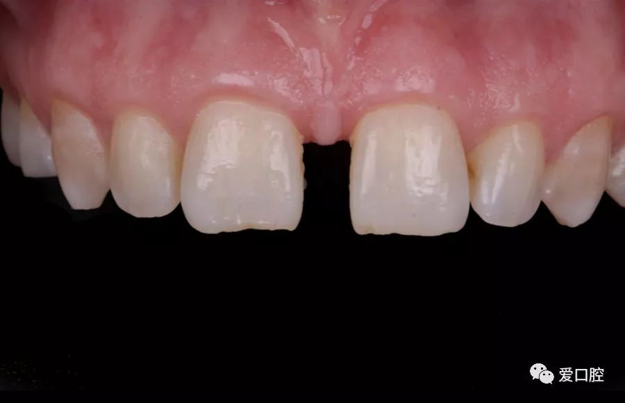 两周复诊后,门牙中间的缝隙开始减少
