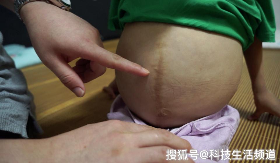 「科技生活频道」原创紧急求救！8岁少女急需救命药 父亲：她的肚子就要破裂而亡了