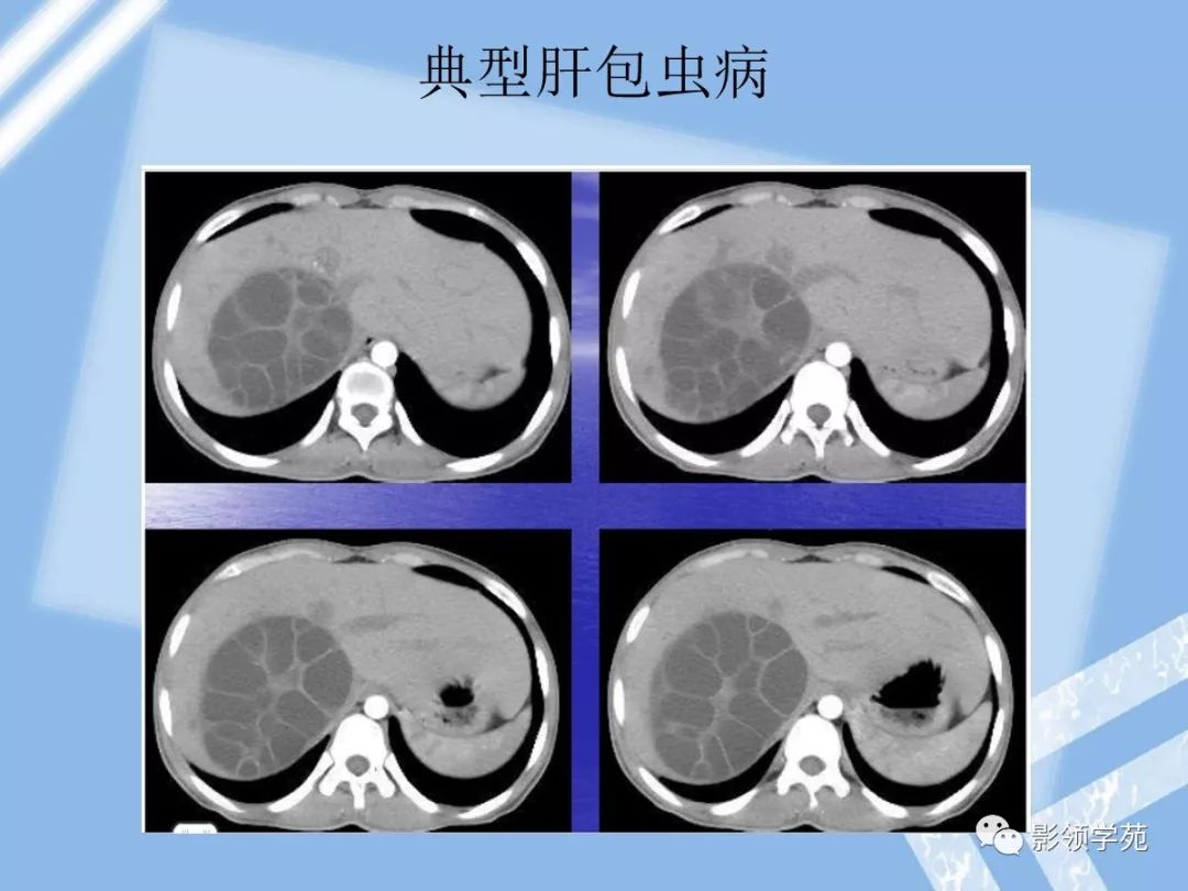 5,肝包虫病4,肾细胞癌肝转移肿瘤膨胀性生长,可有包膜,易出血,坏死