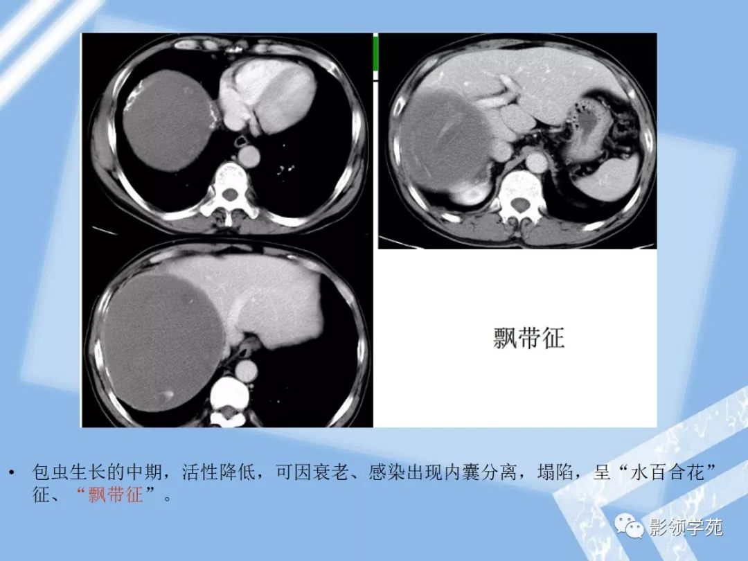 5,肝包虫病4,肾细胞癌肝转移肿瘤膨胀性生长,可有包膜,易出血,坏死,囊