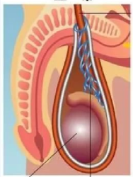 就是精索静脉 静脉曲张早期多无明显自觉症状,少数患者有立位时阴囊坠