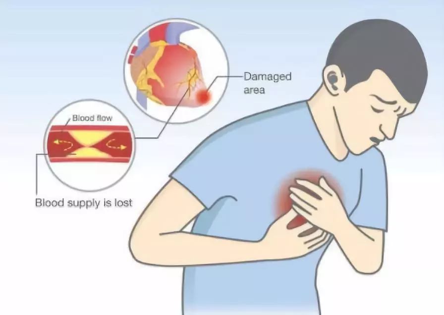 心梗发作急救方法