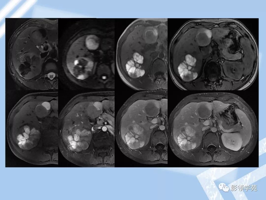 22种肝脏少见及不典型肿瘤的影像表现