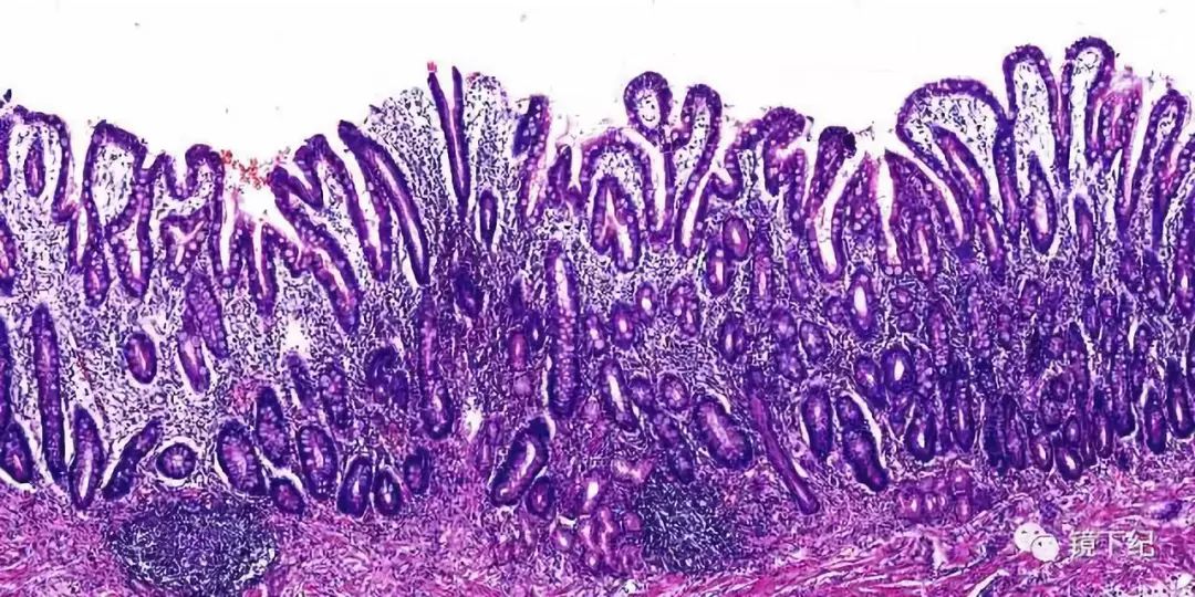 纪小龙肠化萎缩都不是癌只有异常增生才有危险