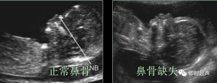 超声鼻骨切面:正中矢状切面和横切面诊断鼻骨缺失时,至少需要在 2 个