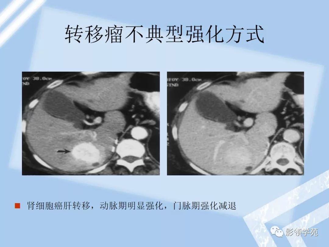 5,肝包虫病