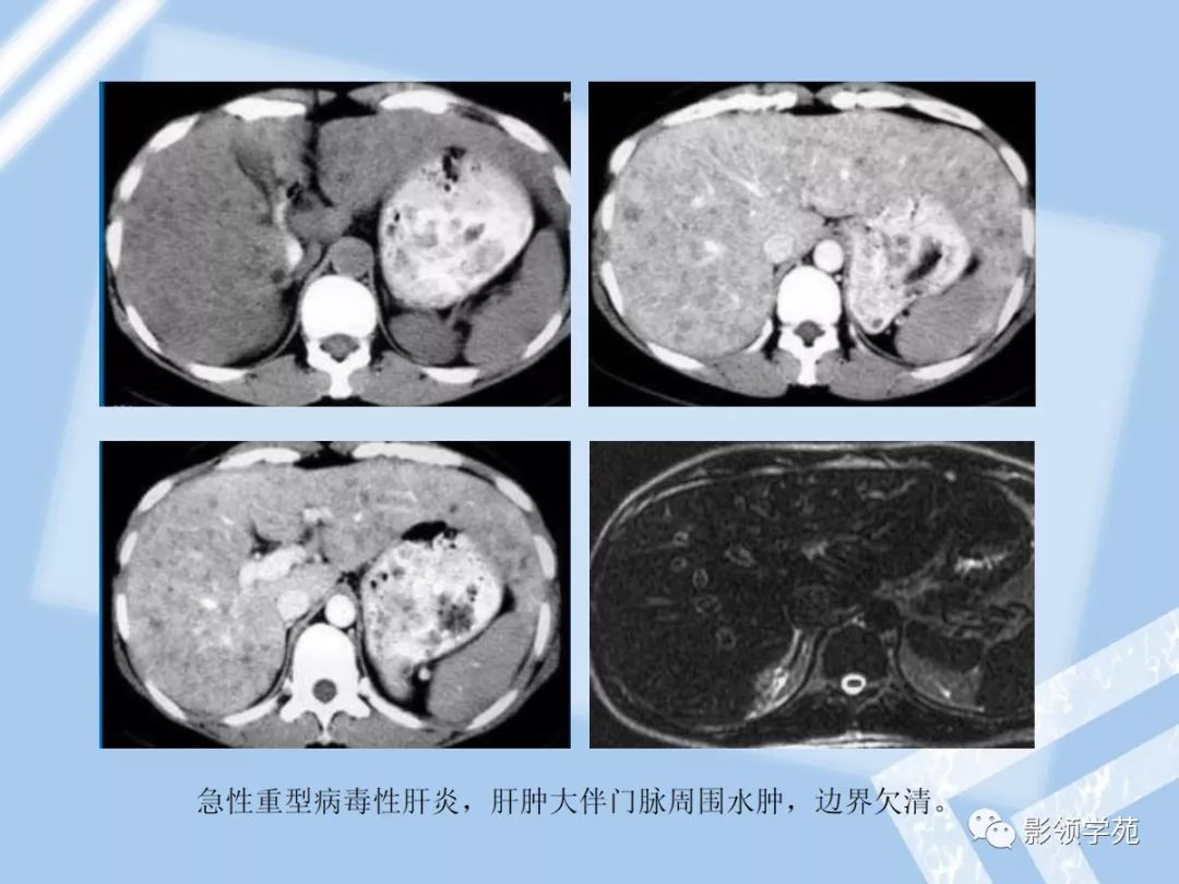 7,急性重症肝炎6,阿米巴脓肿5,肝包虫病4,肾细胞癌肝转移肿瘤膨胀性