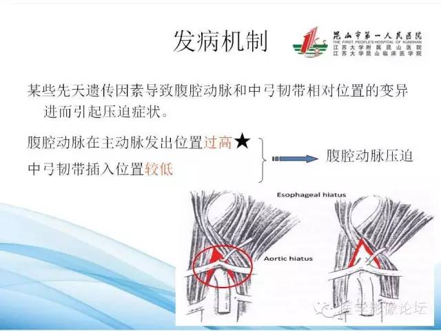 正中弓状韧带致腹腔动脉压迫综合征cta表现