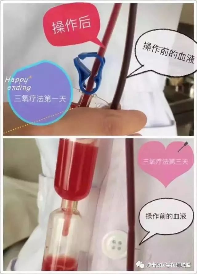 什么是三氧自体血回输疗法免疫三氧自血疗法是用抗氧化专用血袋将患者