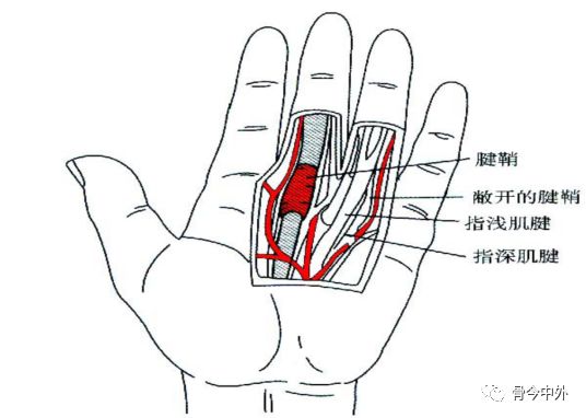 人均腱鞘炎_手腕腱鞘炎图片(3)