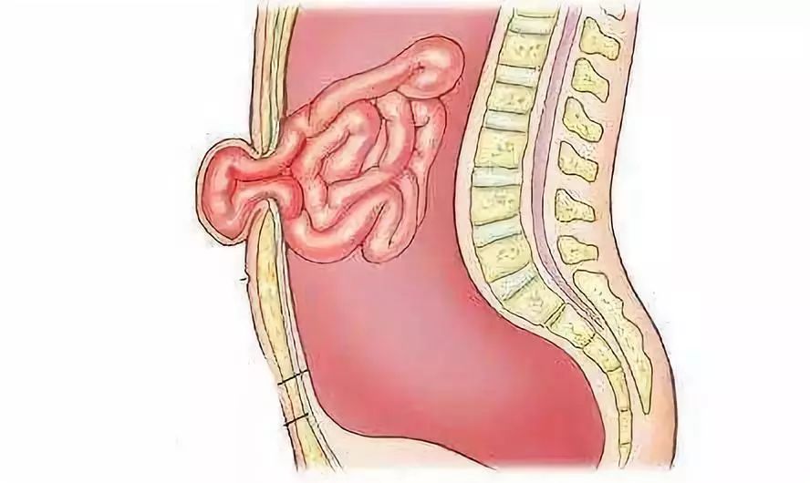 脐疝是腹壁疝的一种,指腹腔内容物(主要是肠管)通过脐孔薄弱处突出于