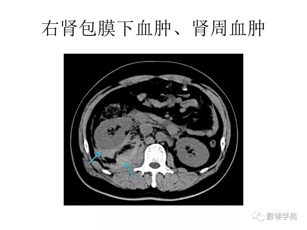 腹部实质性脏器外伤的ct表现_血肿