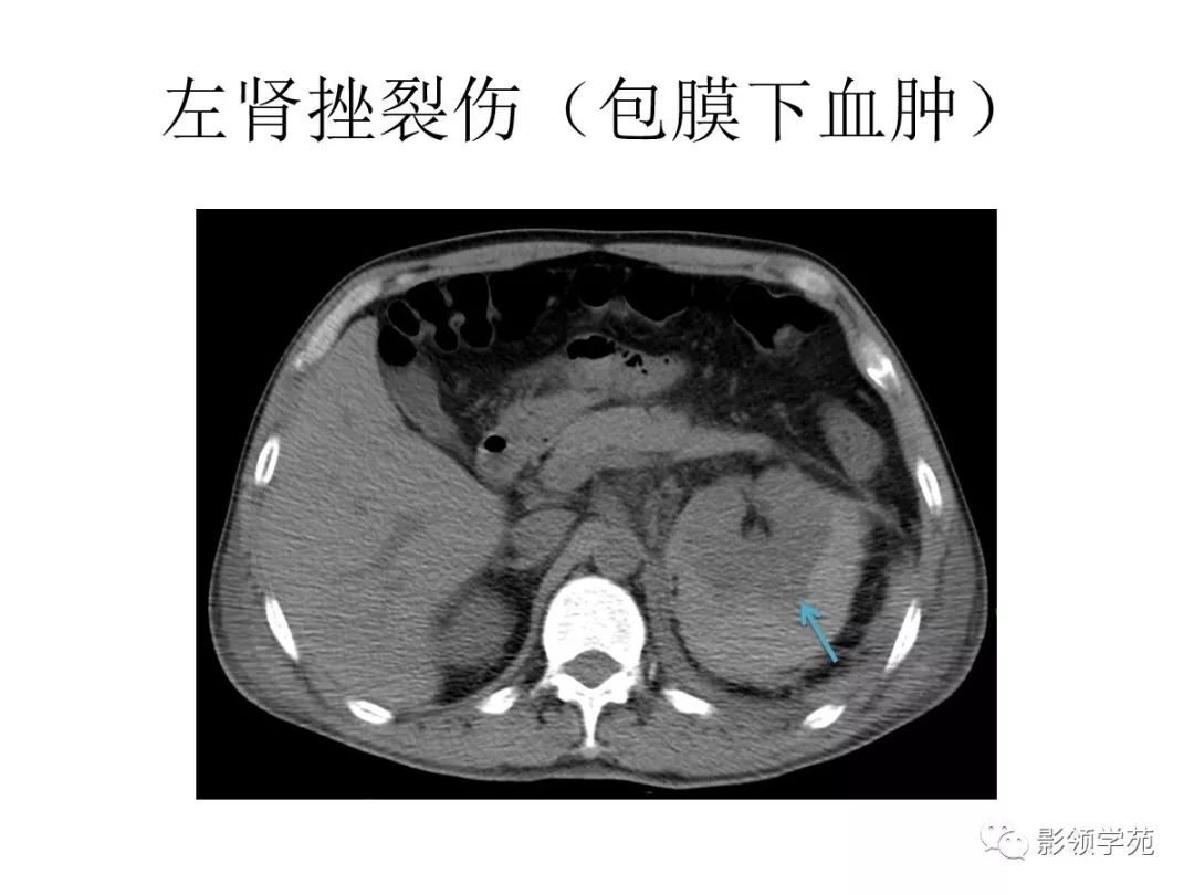 腹部实质性脏器外伤的ct表现_血肿