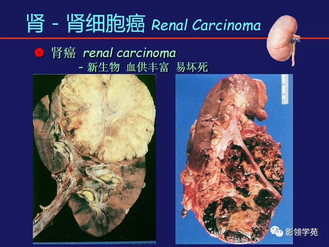 囊变钙化5~20% 点/结节状  双侧5~10%  少见穿破肾包膜或侵犯肾盂