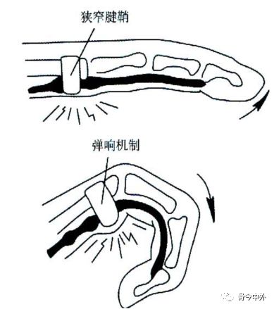 肌腱炎&腱鞘炎,这7种你都知道怎么处理吗?_炎症