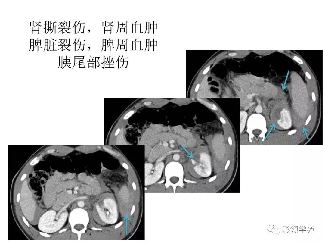 腹部实质性脏器外伤的ct表现