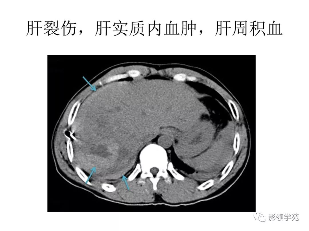 胰腺 泌尿系统 肾脏 脾破裂 分类 完全性破裂 中央破裂 包膜下破裂 ct