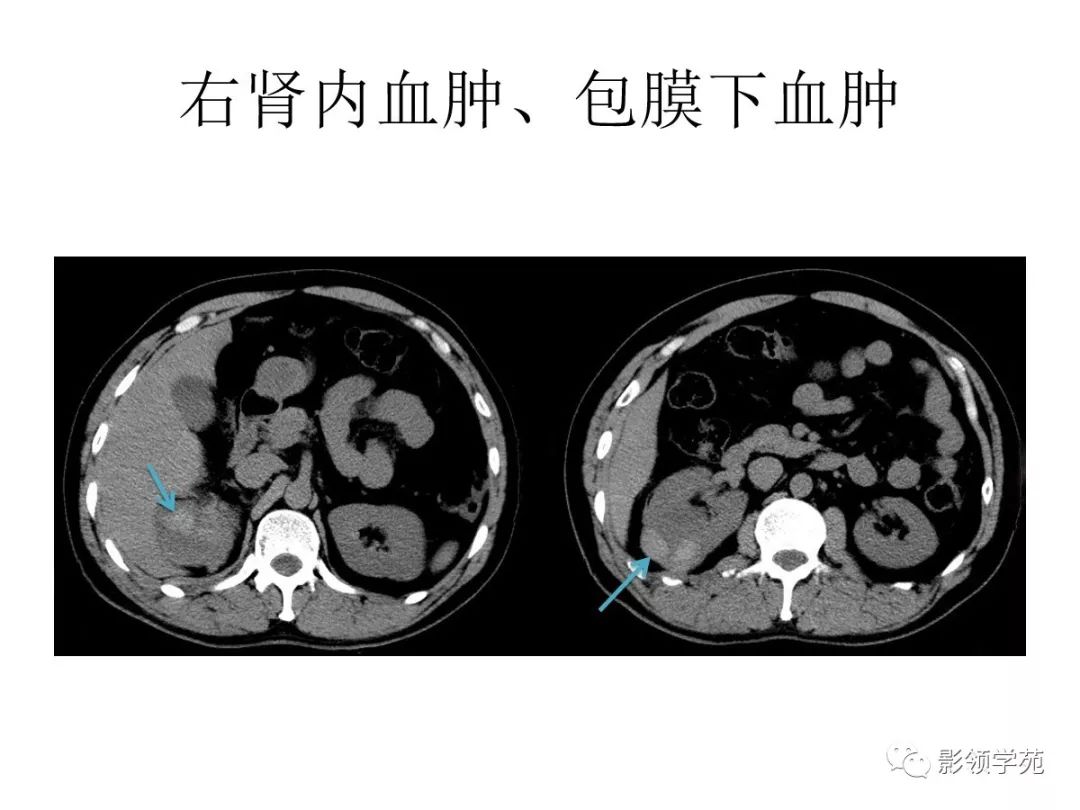 腹部实质性脏器外伤的ct表现_血肿