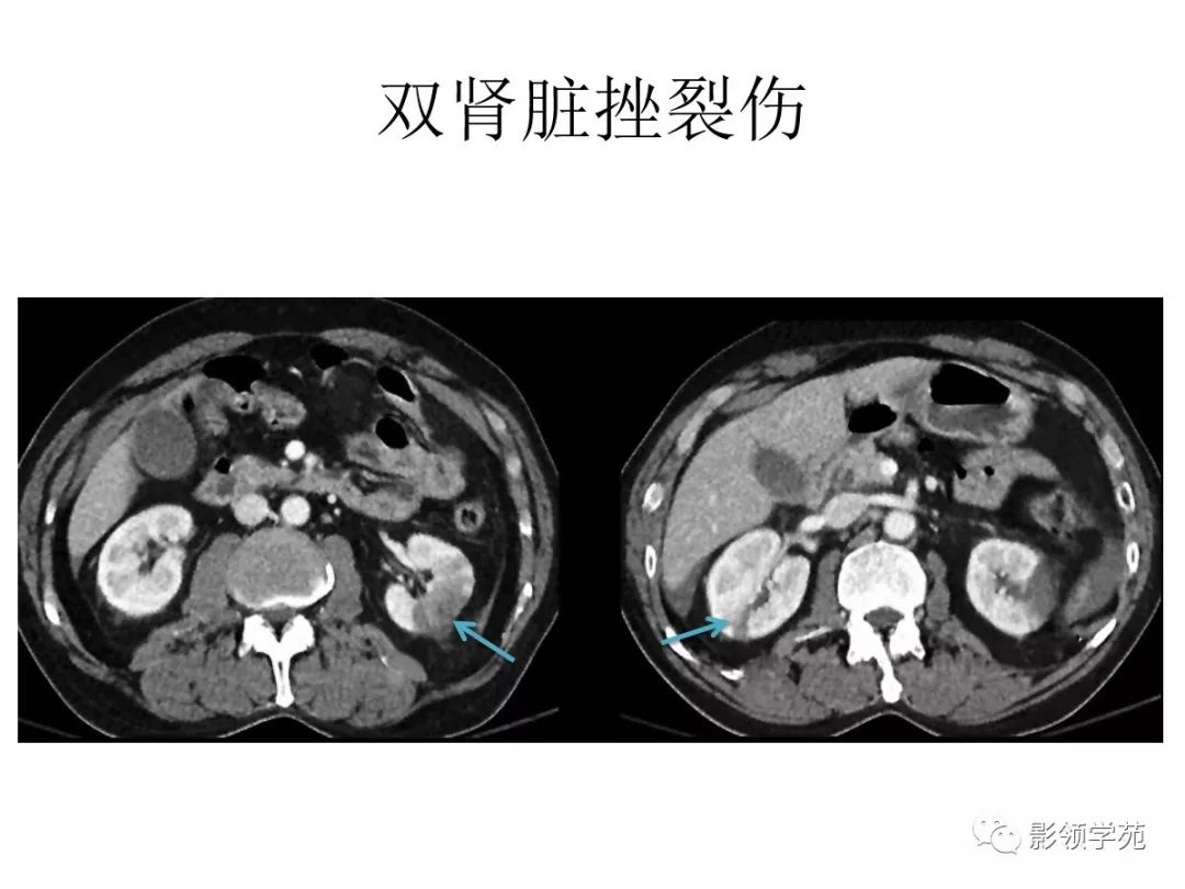 腹部实质性脏器外伤的ct表现