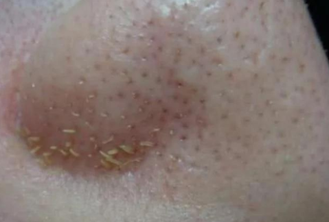 用什么方法可以除螨虫 e9b802b0a10843d7980194deea964533.png