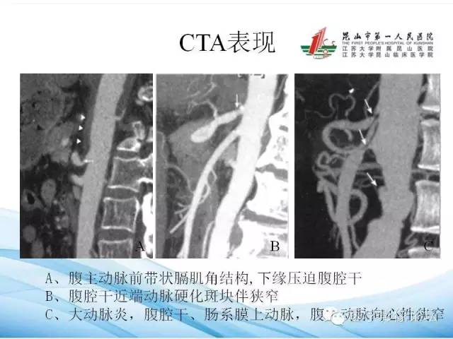 正中弓状韧带致腹腔动脉压迫综合征cta表现