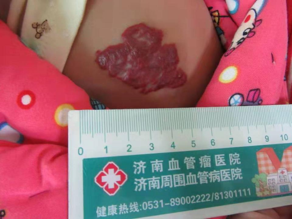 良性血管瘤 来自搜狐网