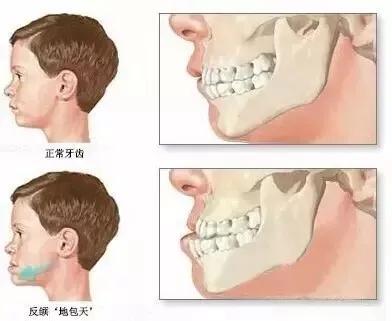 「肥猪嘟嘟」孩子有三次改变牙齿不齐的黄金期，爸妈千万别错过！