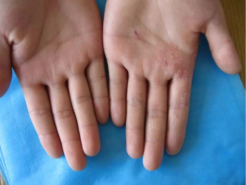 1,角化型手足癣:单手或双手受累及,呈现为无水疱的环形脱屑斑;日久者