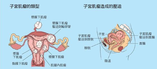 什么情况会引起子宫肌瘤 e785968a9fb04ac580ce1e764c2367b2.jpeg