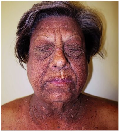 色素沉着斑块图片 325df5a5d3704787920cdf8f505dc33d.jpeg