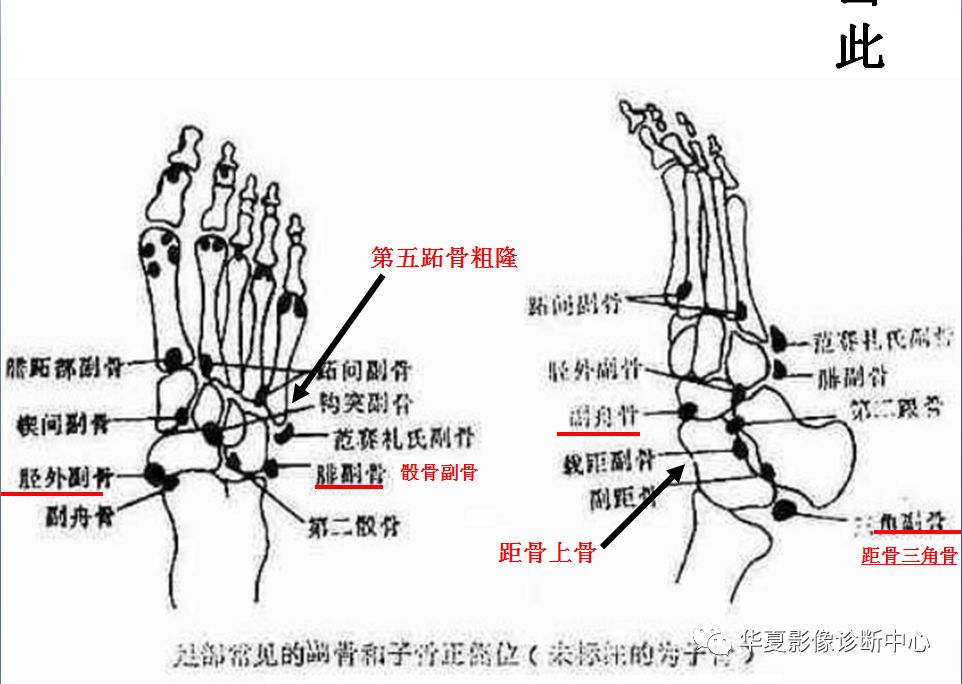 籽骨,副骨,永存性骨骺 与撕脱性骨折,傻傻分不清!