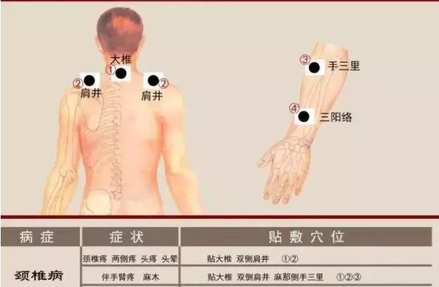 颈椎病穴位敷贴