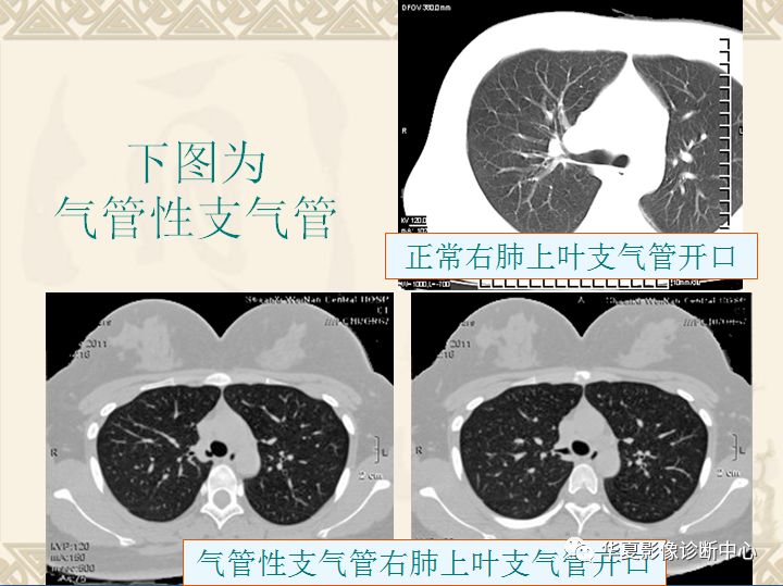 支气管起源异常的ct诊断