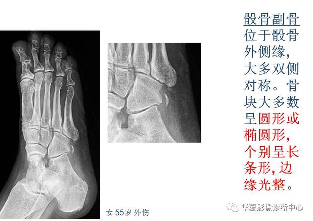 籽骨,副骨,永存性骨骺 与撕脱性骨折,傻傻分不清!