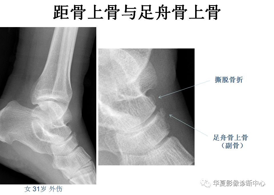 籽骨副骨永存性骨骺与撕脱性骨折傻傻分不清