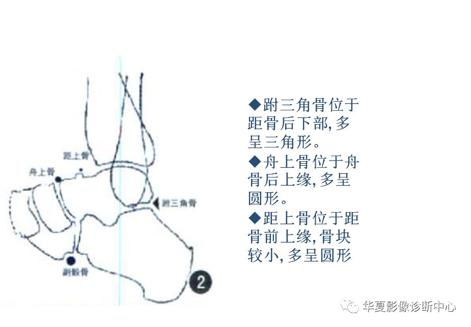 籽骨副骨永存性骨骺与撕脱性骨折傻傻分不清