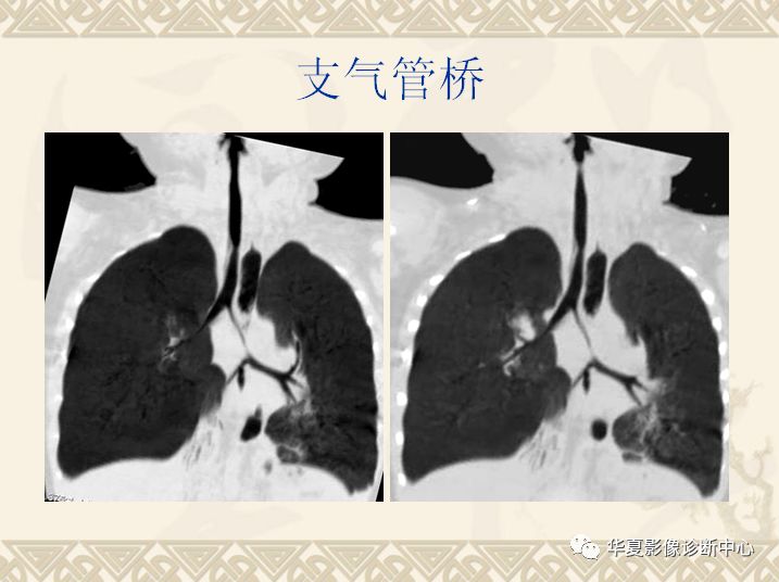 支气管起源异常的ct诊断