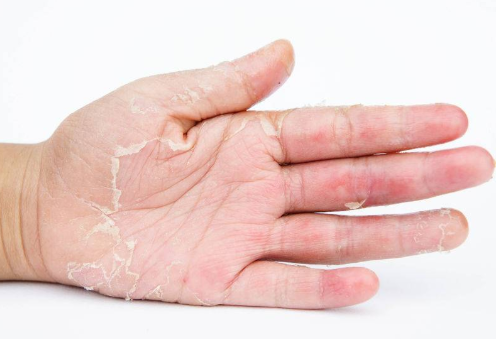 手什么时候脱皮 c2bf0d60eb7149a58dd0c48548c80e17.png