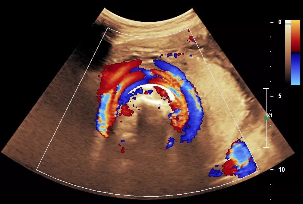 cdfi可见六条(两组)血管平行环绕胎儿颈部,两组脐动脉血流方向一致,两