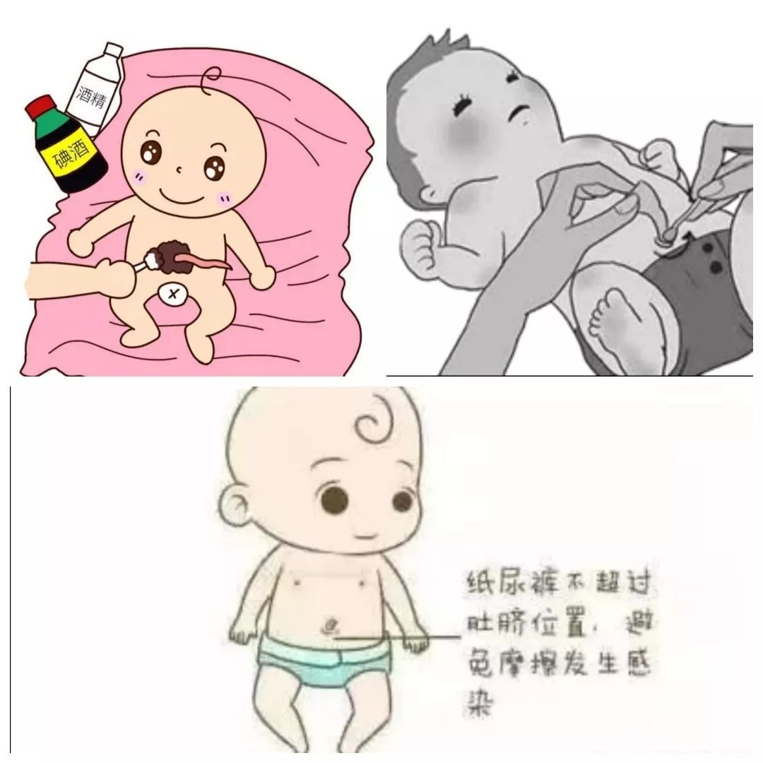 如何做好新生儿脐部护理