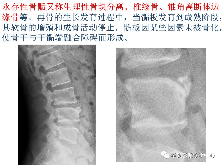 籽骨,副骨,永存性骨骺 与撕脱性骨折,傻傻分不清!